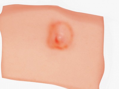 従来の治療方法 手順1