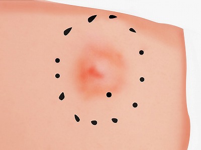 従来の治療方法 手順2