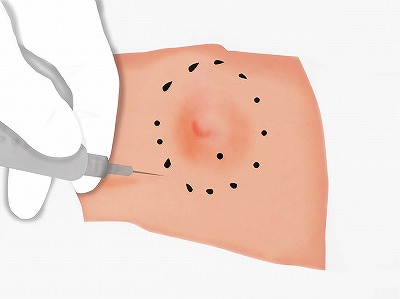 従来の治療方法 手順3