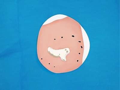 従来の治療方法 手順6