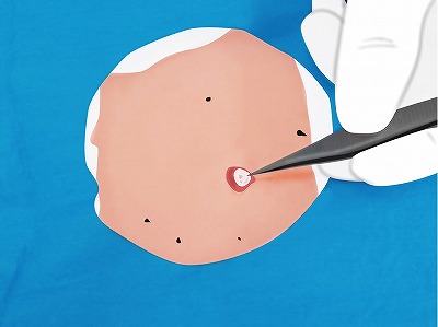 従来の治療方法 手順6