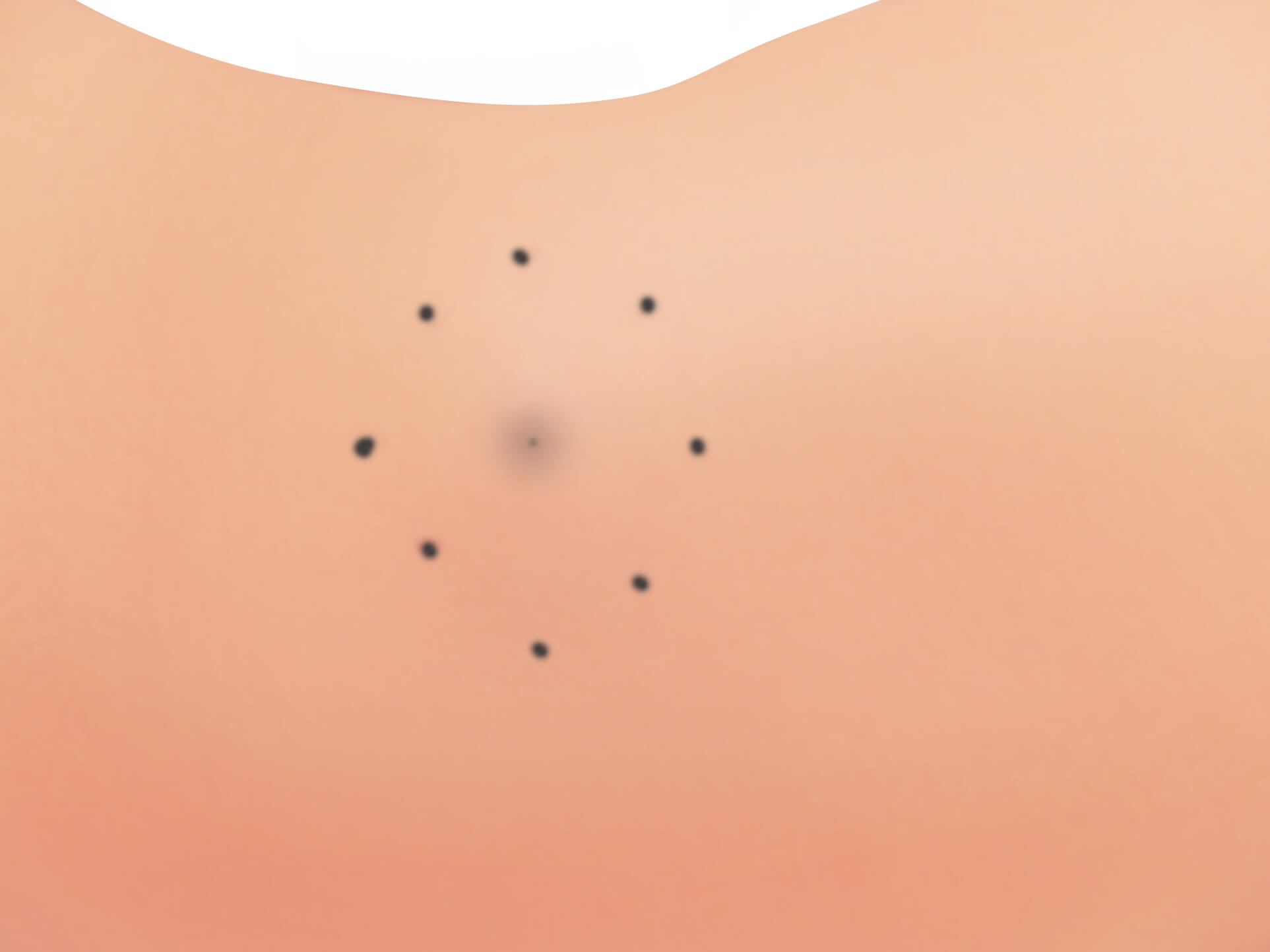 従来の治療方法 手順1