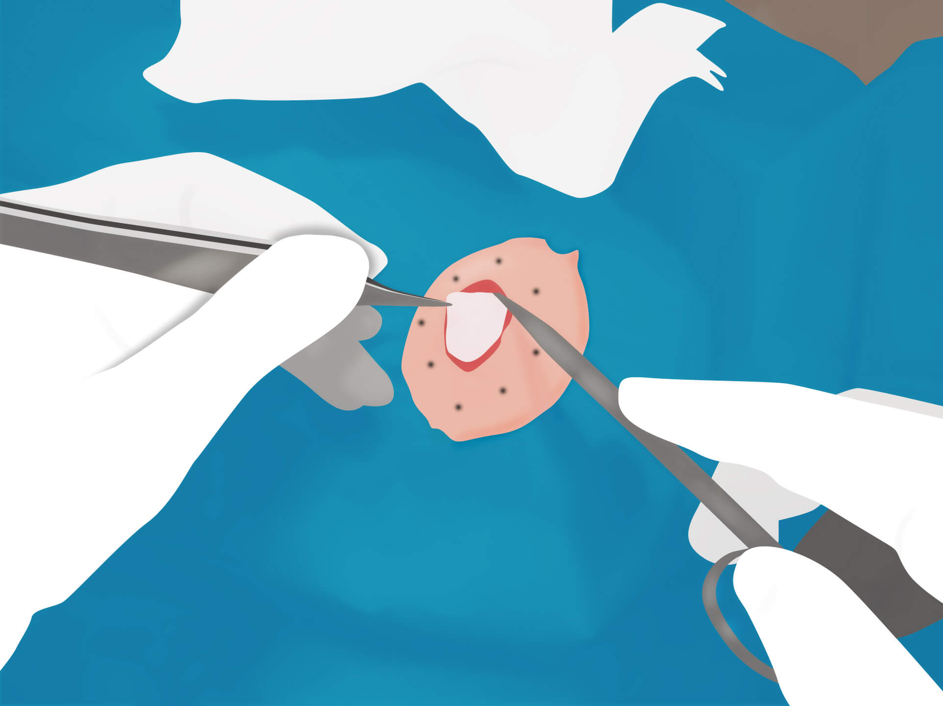 従来の治療方法 手順4