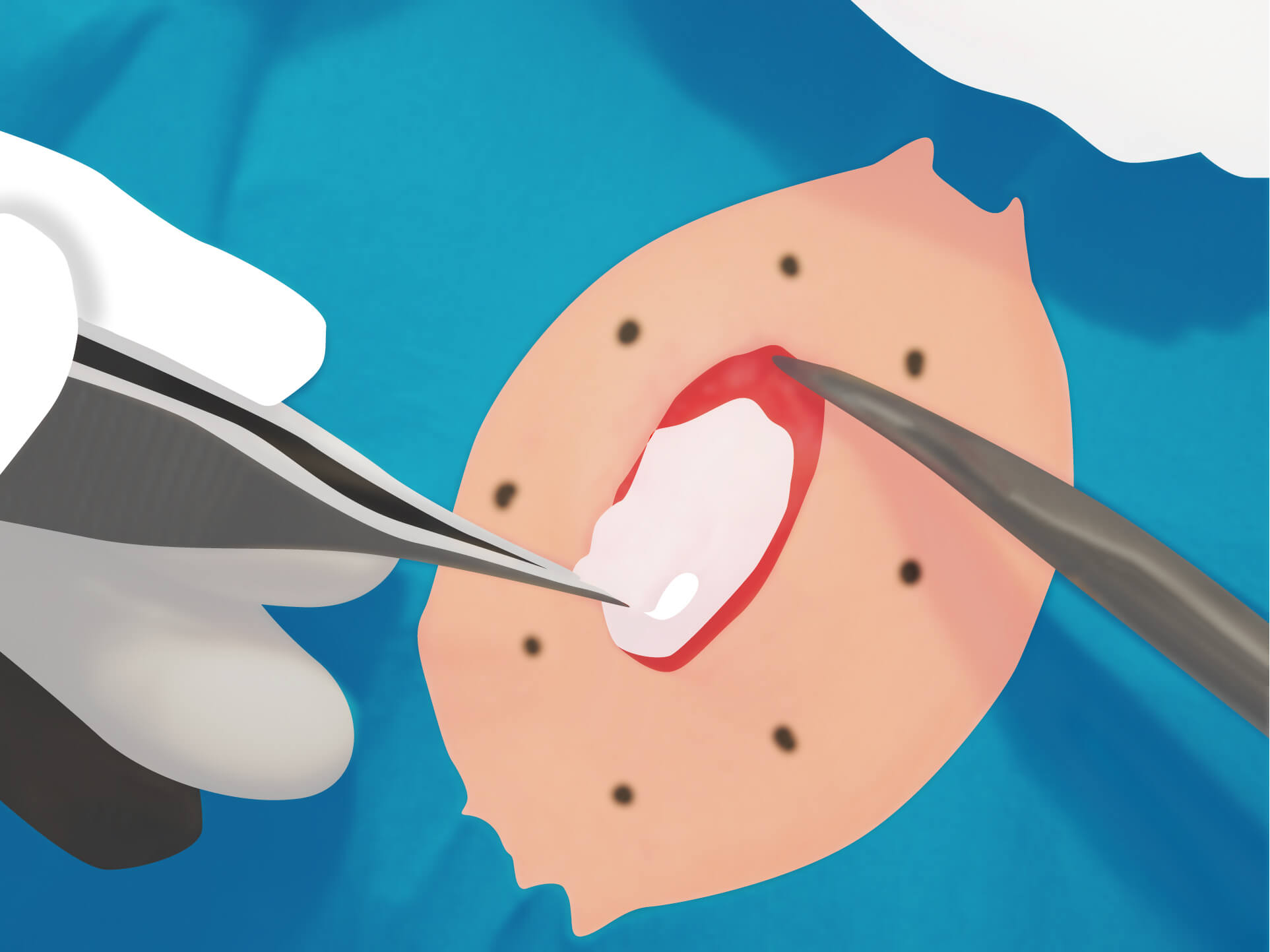 従来の治療方法 手順5