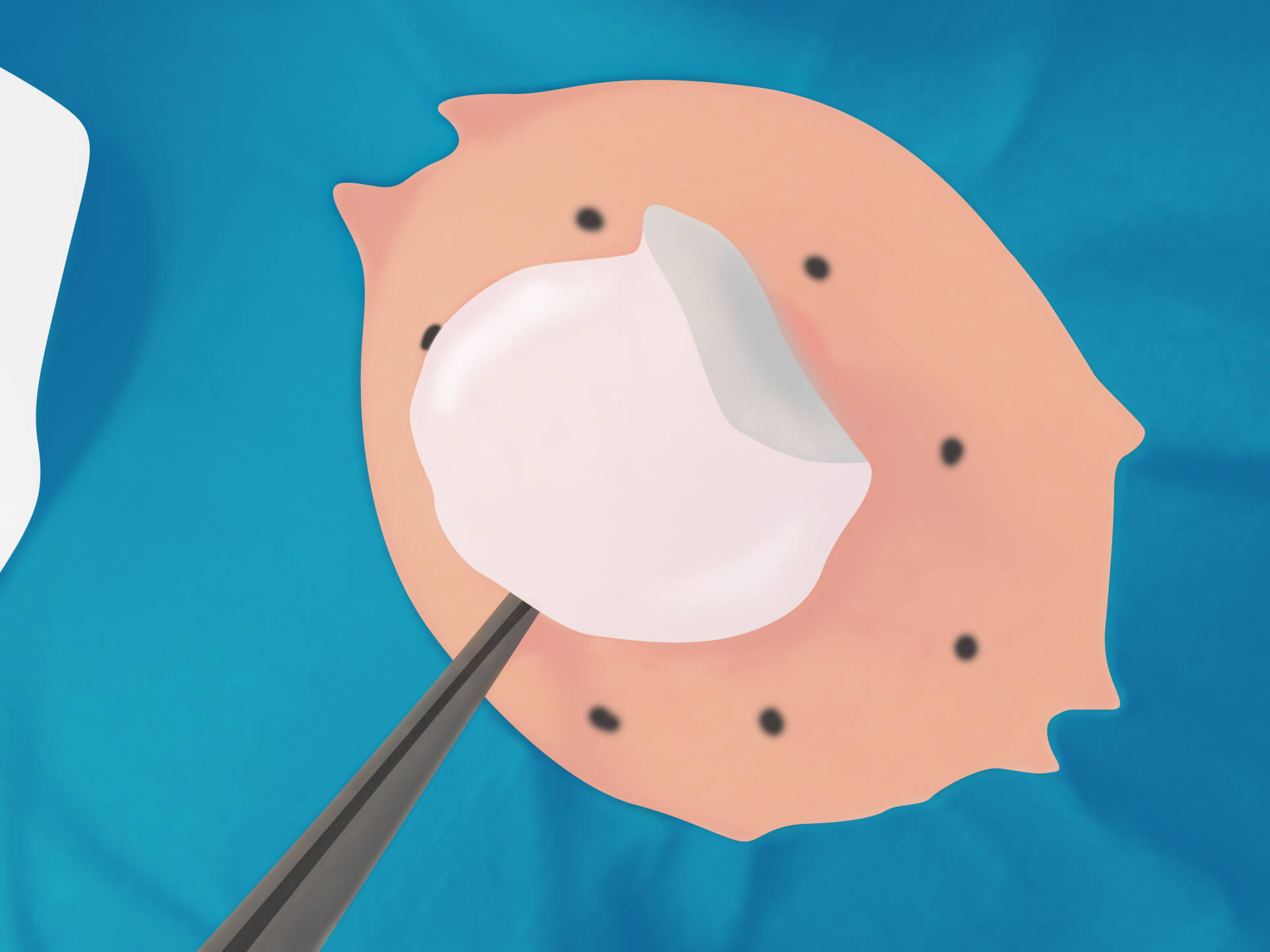 従来の治療方法 手順6