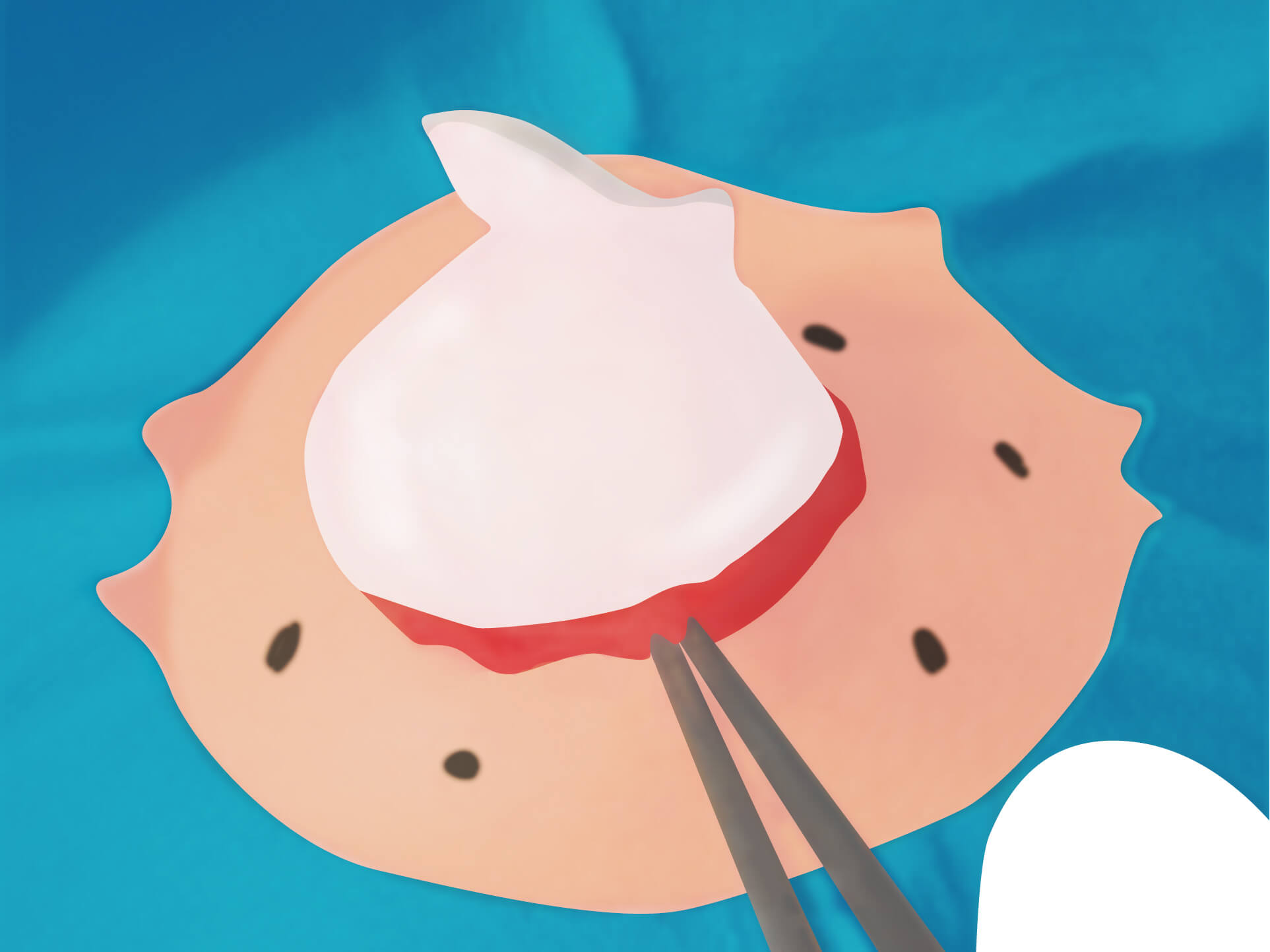 従来の治療方法 手順7