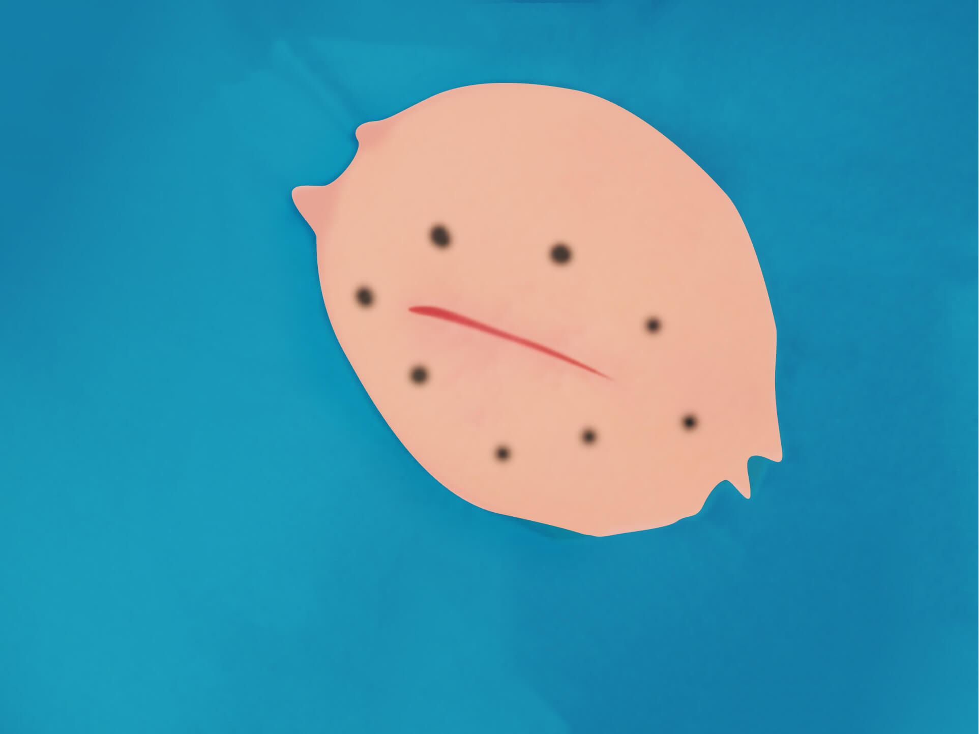 従来の治療方法 手順11