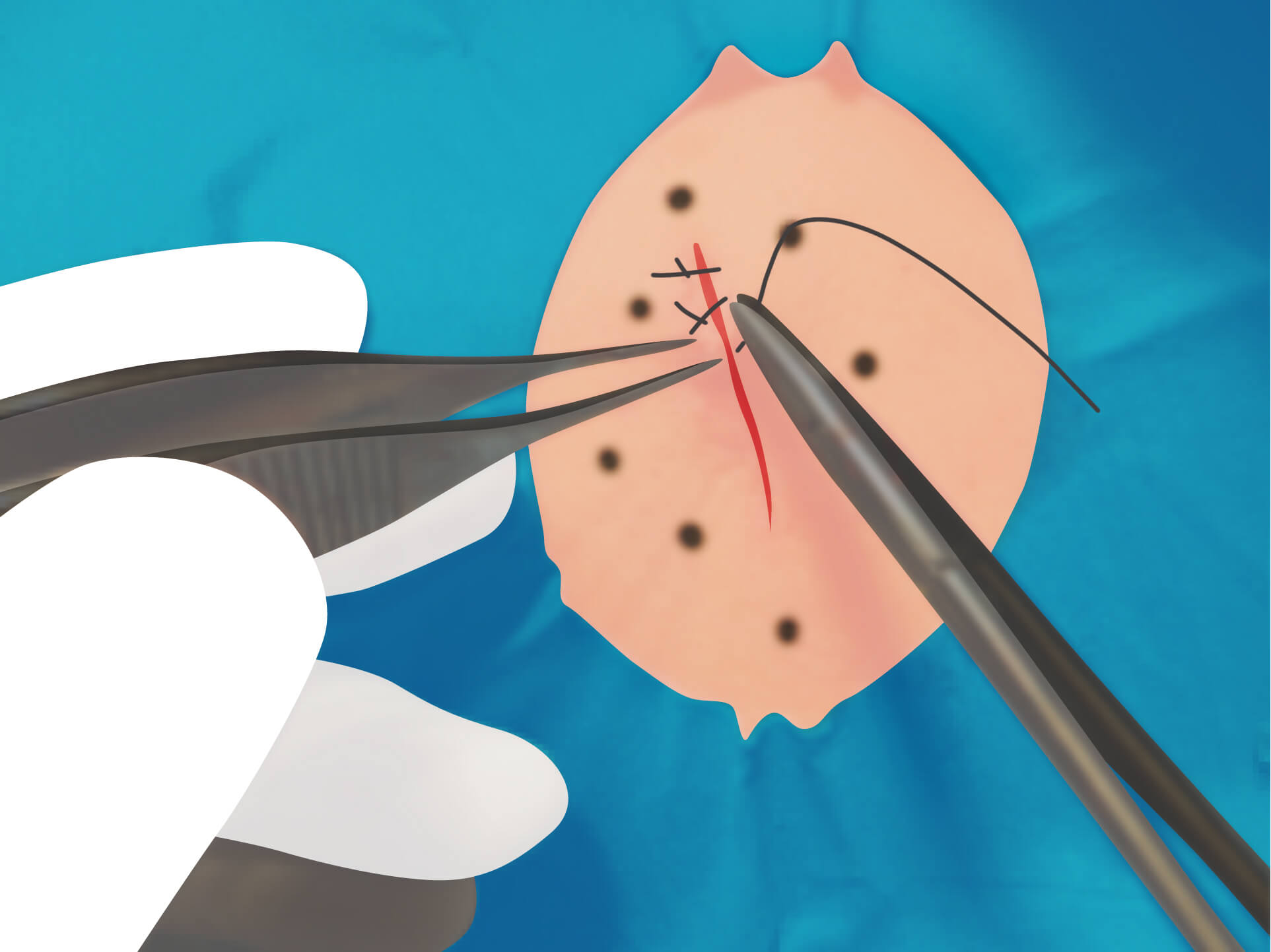 従来の治療方法 手順12